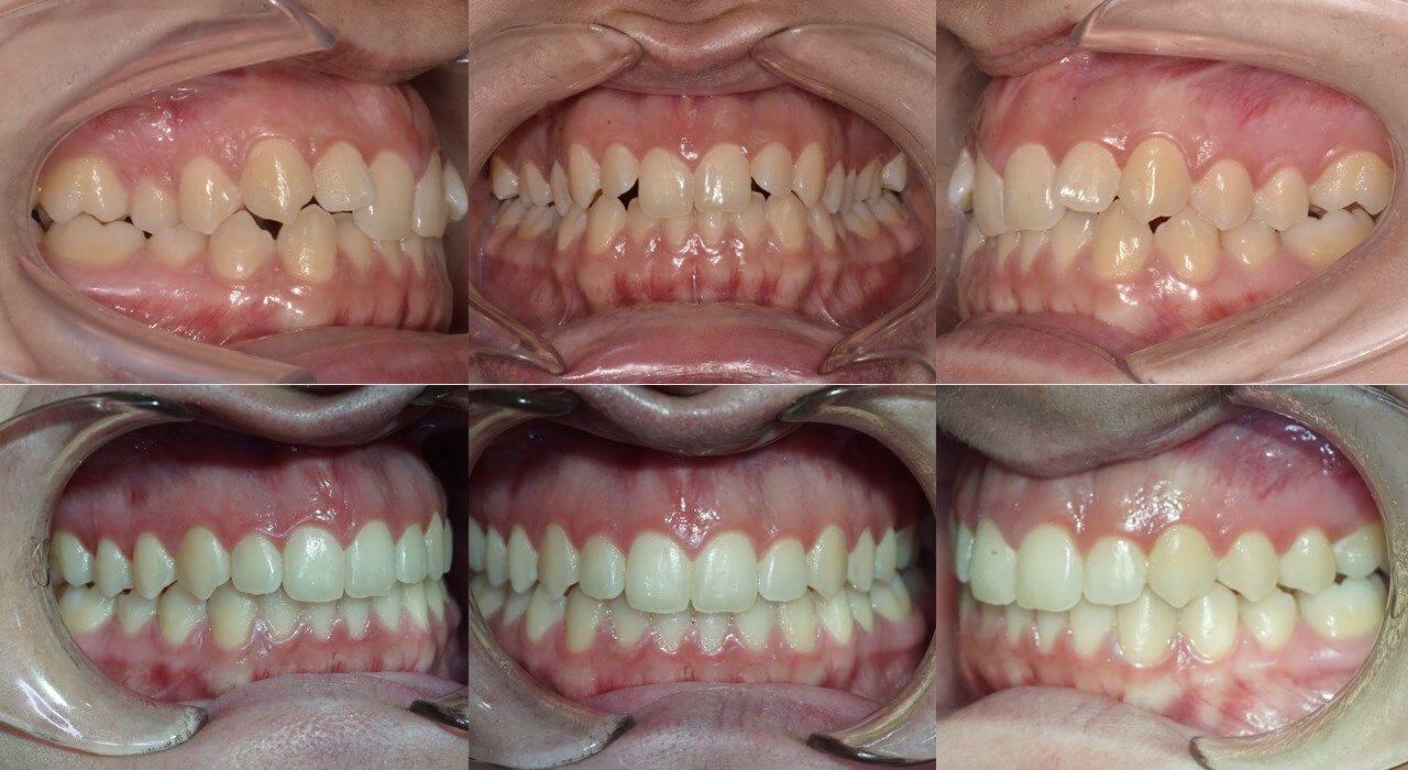 cazuri clinice OrtoEestetic: aparate dentare Invisalign Cluj